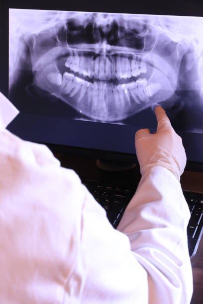 Best Emergency Wisdom Tooth Extraction in Minersville, PA