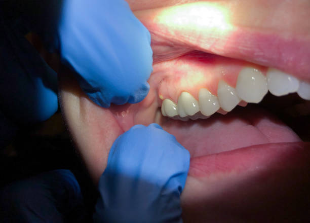 Best Knocked-Out Tooth (Avulsed Tooth) Treatment in Minersville, PA